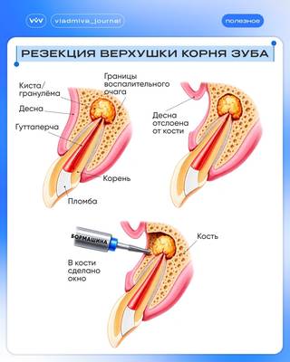 Резекция верхушки корня: когда воспаление не отступает.